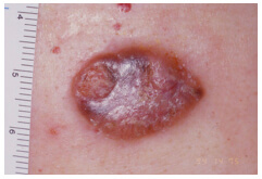 Carcinoma Spinocellulare